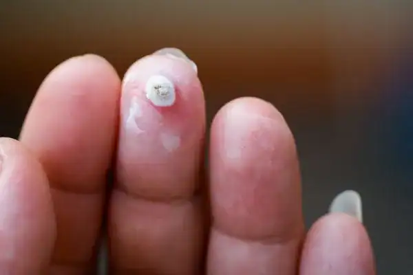 Image of white wart before cryopen treatment Old Trafford