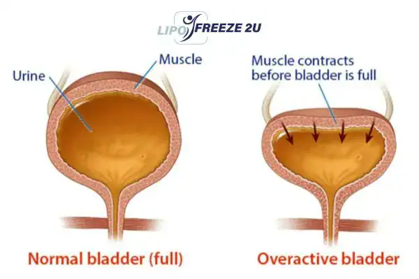 diagram of overactive bladder treatment Old Trafford
