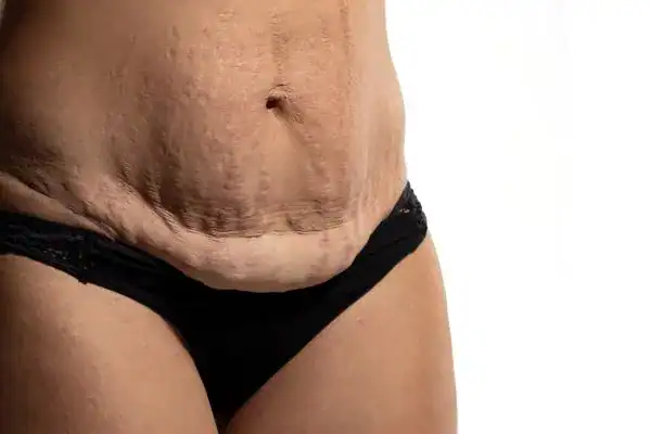 loose skin after weight loss injections Old Trafford