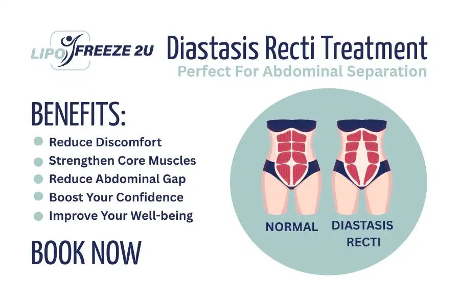 How Long Will It Take to See Improvements in Diastasis Recti Old Trafford