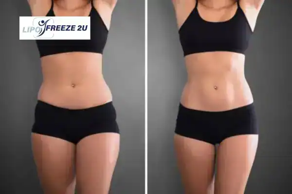 How Can LIPO FREEZE 2U Support Your Post-Pregnancy Body Recovery Old Trafford?