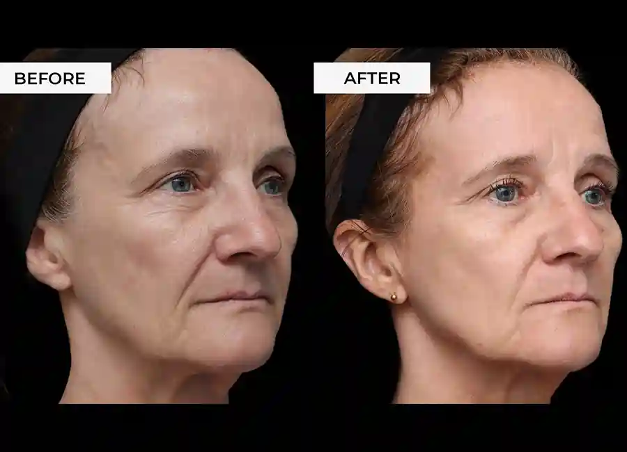 How Many RF Microneedling Sessions Will You Need to See a Difference Old Trafford?